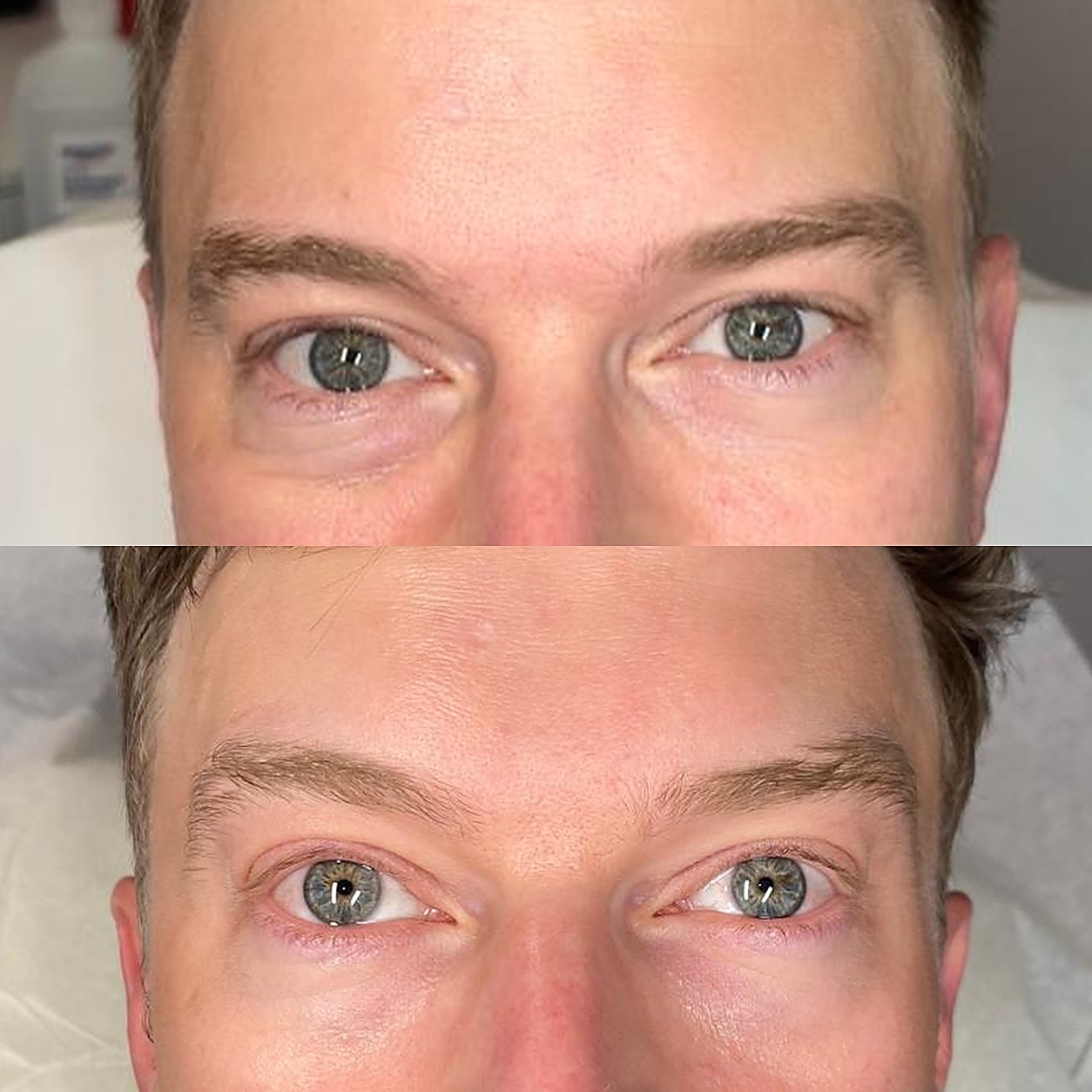 eye-rejuvenation